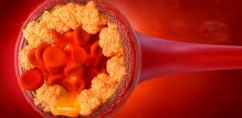 Lipoprotein(a) ili Lp(a) je specifična vrsta LDL kolesterola poznata po svojoj ljepljivosti