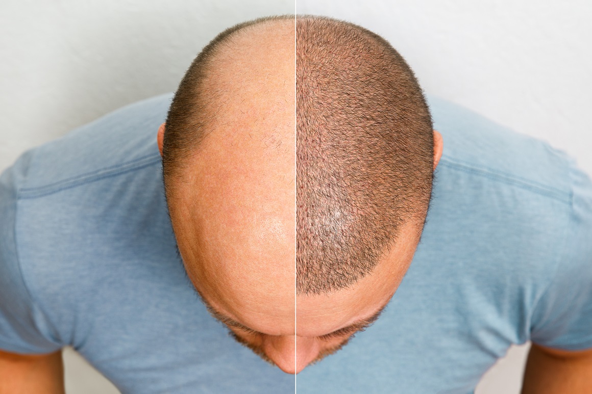 U kasnijim fazama muške ćelavosti transplantacija kose je jedna od opcija