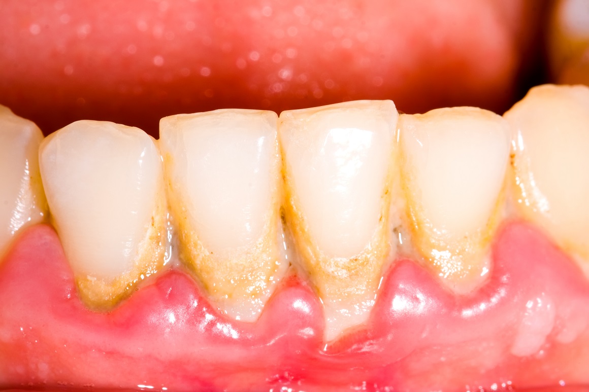 Zubni kamenac stvrdnuta je naslaga koja se stvara na zubima