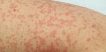 Alergija na penicilin - simptomi