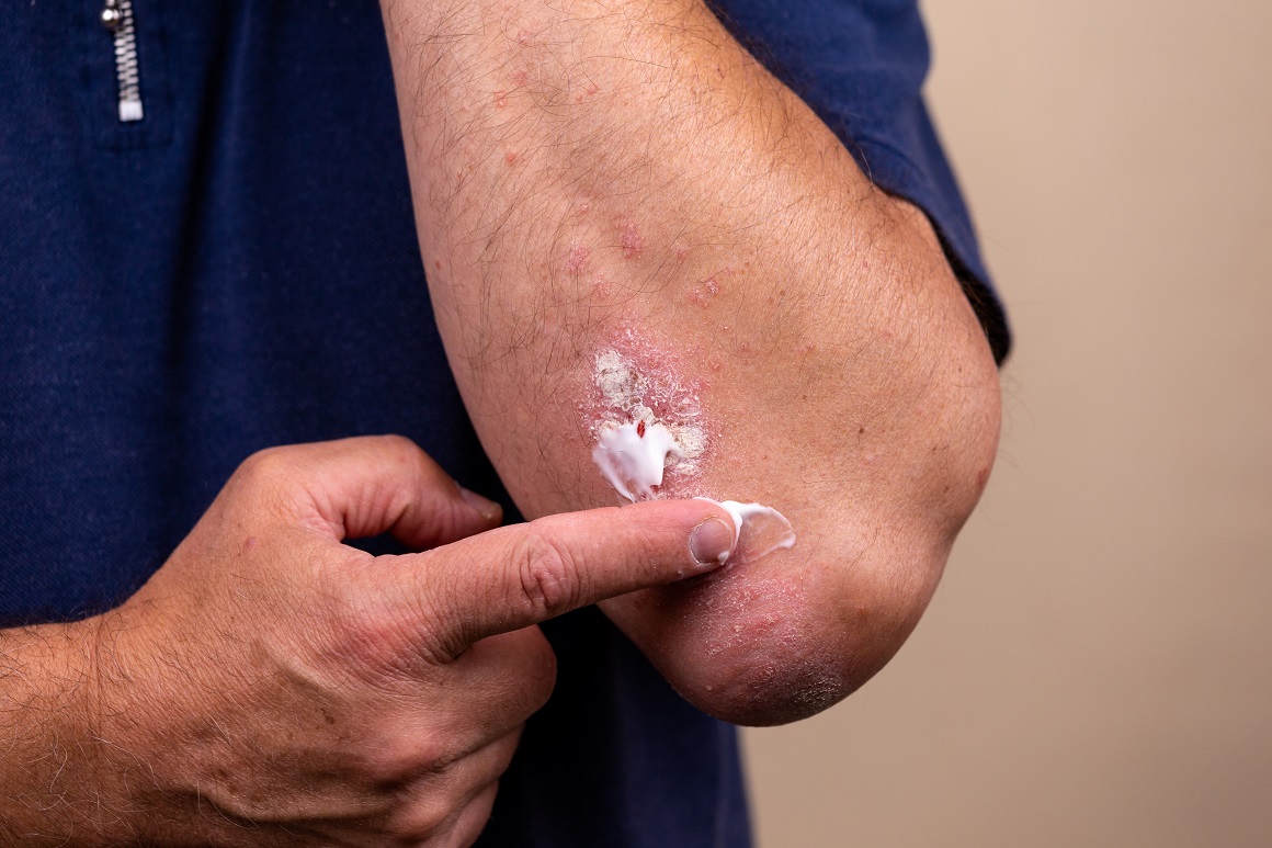 Atopijski dermatitis je dugotrajna upalna kožna bolest koja prvenstveno zahvaća područja poput lica, šaka, stopala ili kožnih nabora oko laktova i koljena