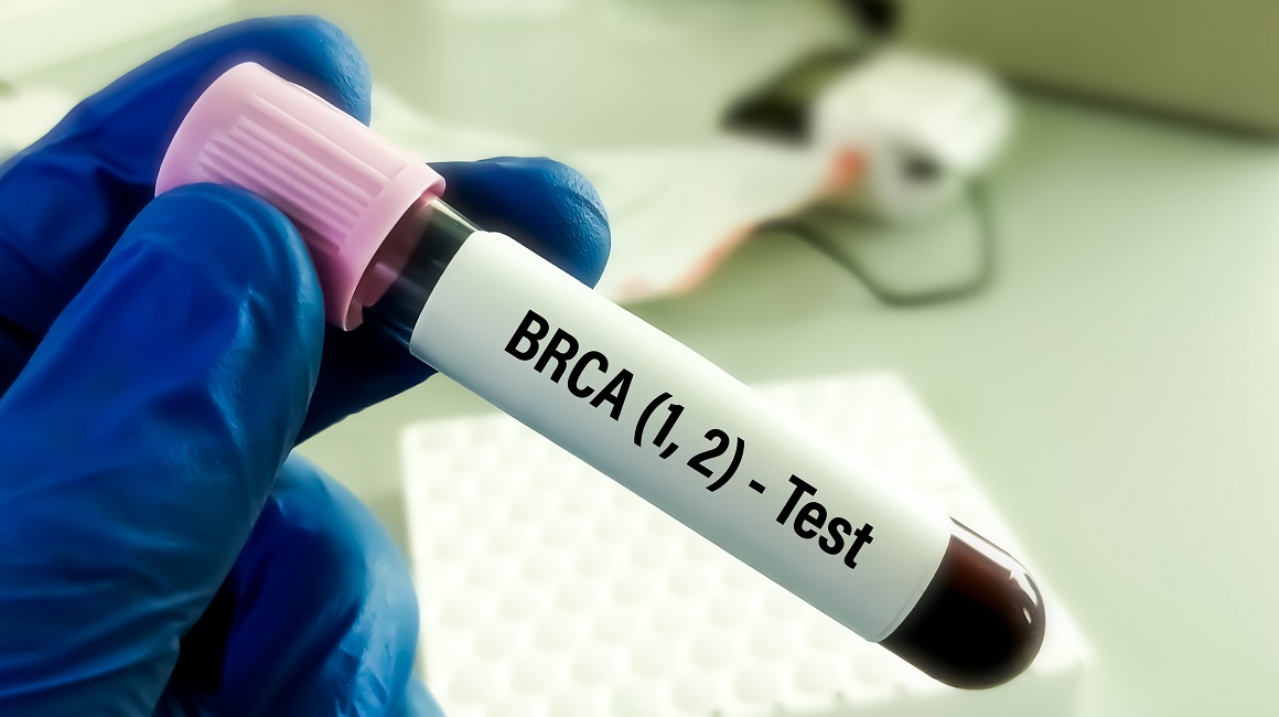BRCA testiranja zaista mogu pomoći zdravim ženama da utvrde visoki rizik od razvoja raka dojke i raka jajnika