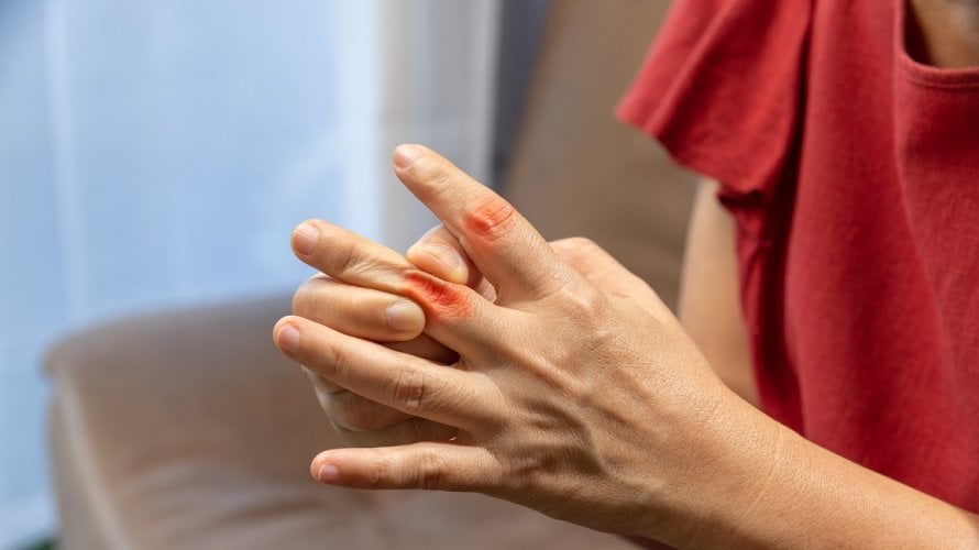 Bol u zglobovima i oticanje ključni su pokazatelji ozbiljnosti reumatoidnog artritisa