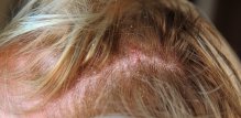 Psorijaza na glavi - simptomi