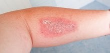 Staphylococcus aureus je bakterija koja se često nalazi na koži i u nosnim prolazima