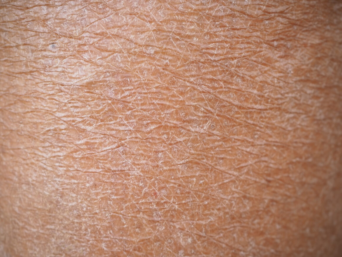 Suha koža može biti neugodan problem, osobito tijekom određenih godišnjih doba