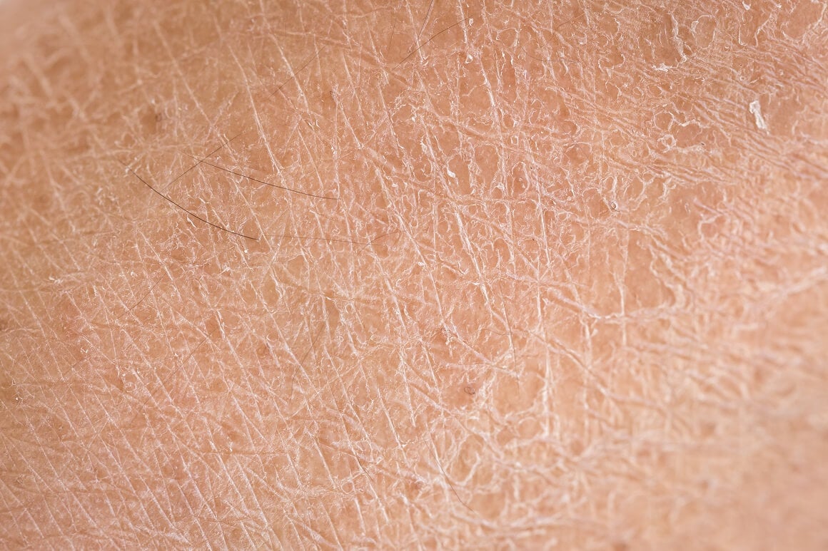 Suha koža se javlja kada koži nedostaje potrebna vlažnost da ostane hidratizirana
