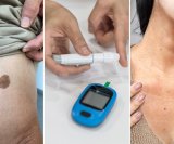 Znakovi dijabetesa na koži