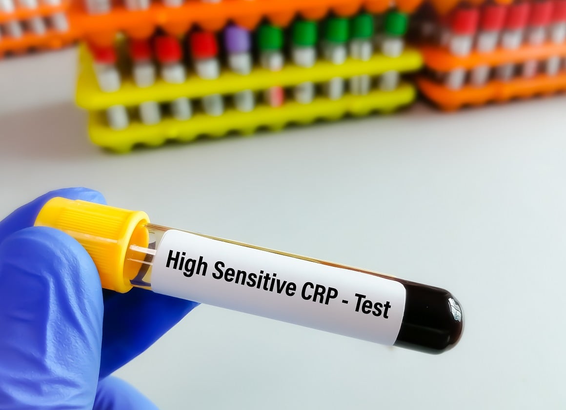 CRP, dobiven jednostavnim testom krvi, služi kao opći marker upale u cijelom tijelu
