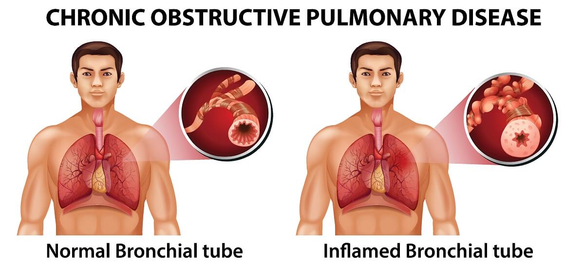 Kronična opstruktivna plućna bolest (KOPB) je kronična bolest pluća koja uzrokuje poteškoće s disanjem