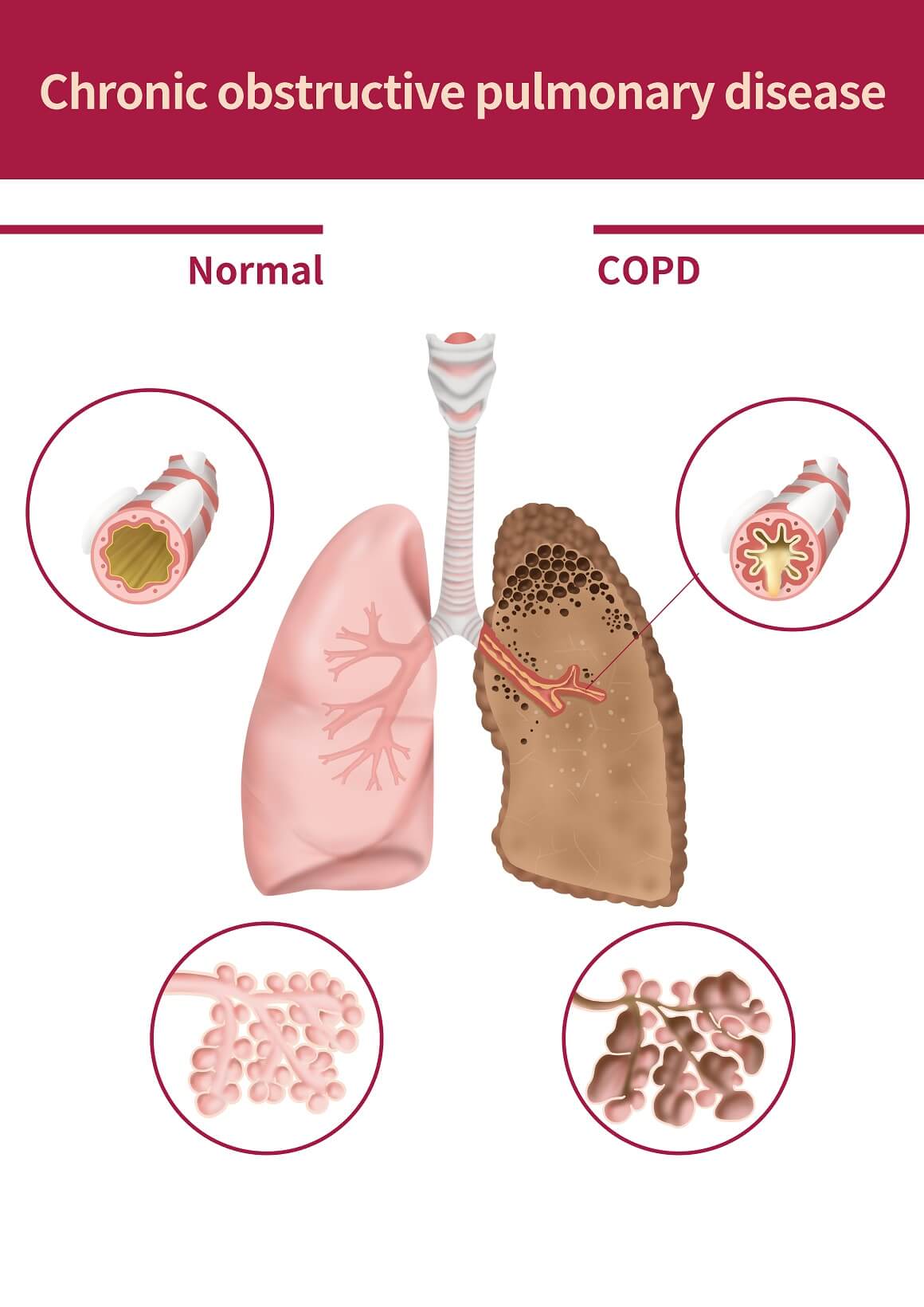 Kronična opstruktivna plućna bolest (KOPB) je naziv za skupinu kroničnih plućnih stanja