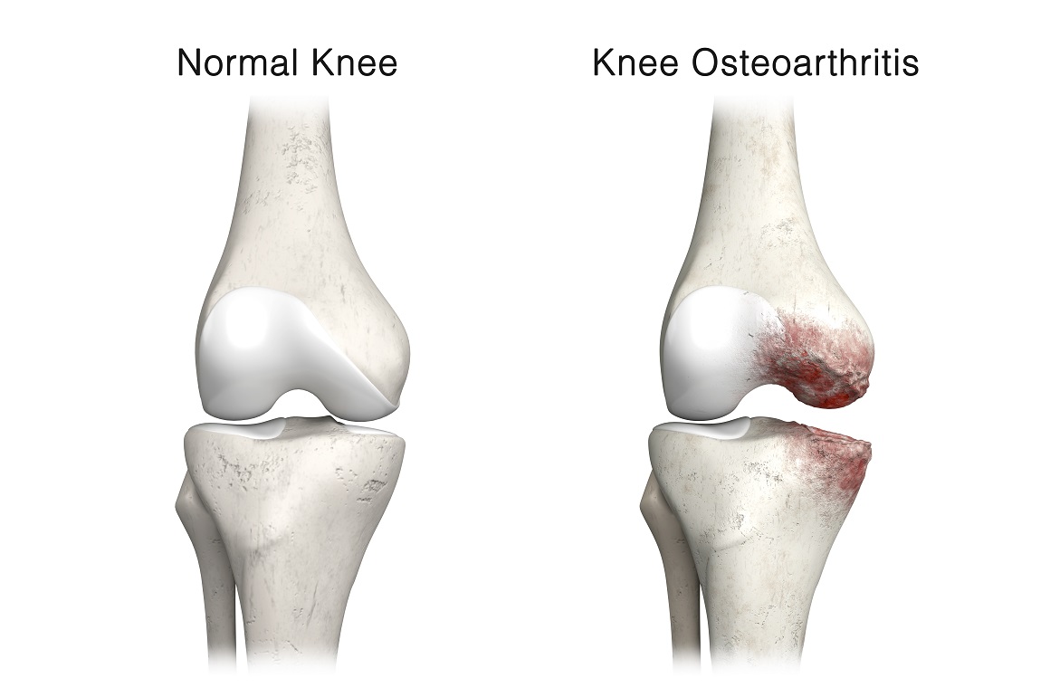 Osteoartritis koljena