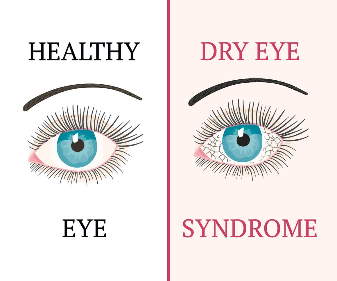 Suhe oči uzrokovane su nizom razloga koji remete zdravi suzni film koji ima tri sloja