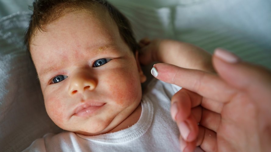 Utvrđeno je da su djeca s postojećim atopijskim dermatitisom sklonija alergijskom kontaktnom dermatitisu