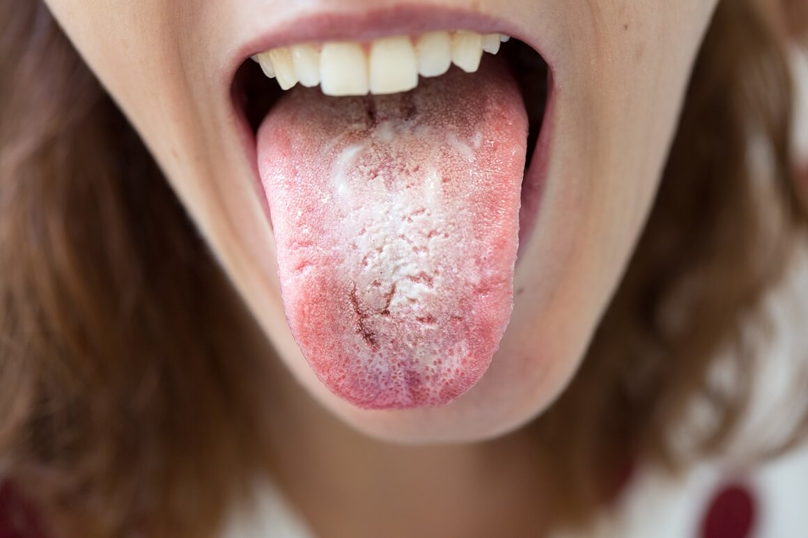Gljivične infekcije poput soora u ustima također mogu signalizirati loše kontrolirani dijabetes