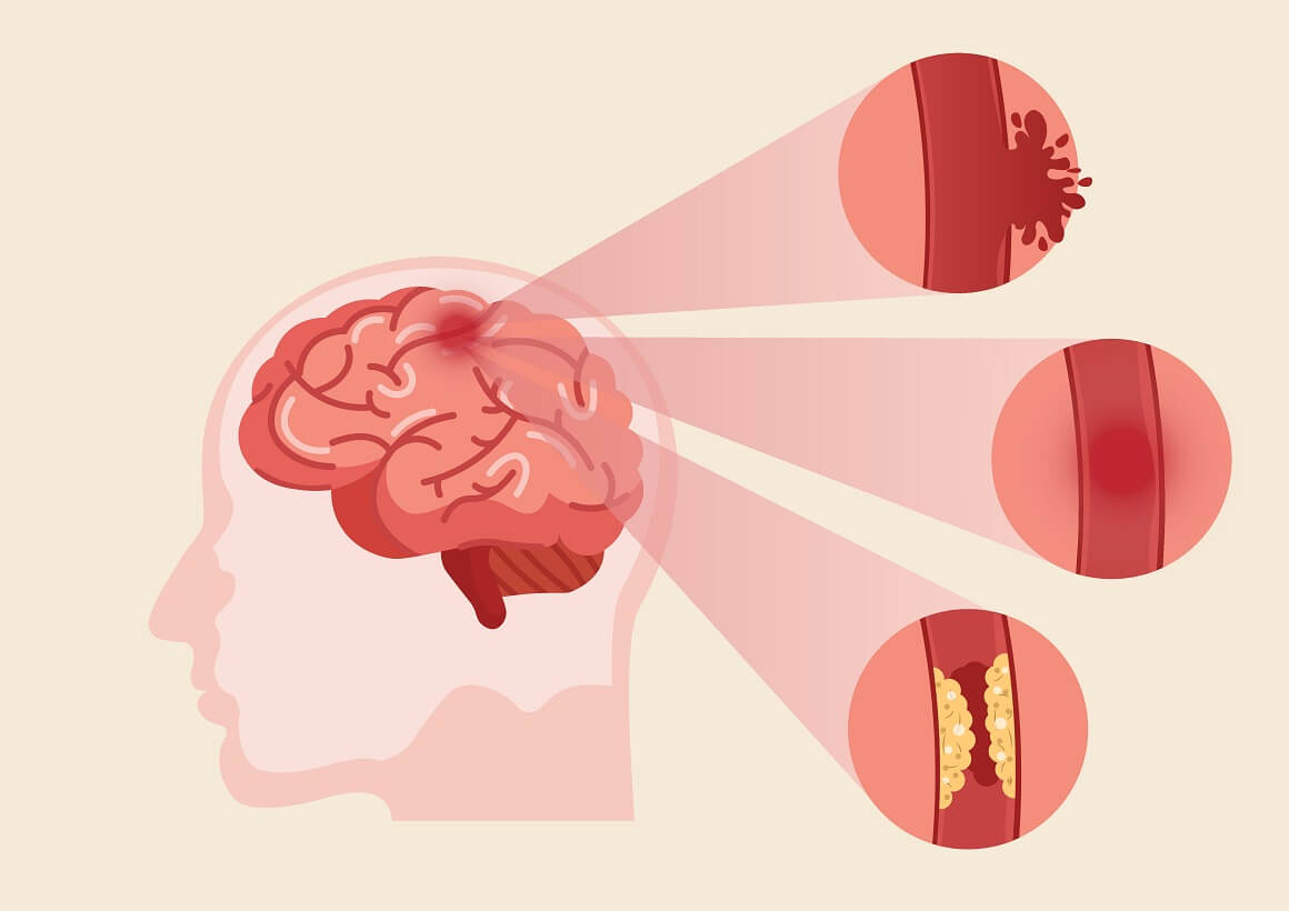 Tri primarna tipa moždanog udara uključuju ishemijski, hemoragijski i prolazni ishemijski napad (TIA)