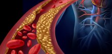 Visoke razine kolesterola lipoproteina niske gustoće (LDL) često dovode do taloženja masnih naslaga u stijenkama krvnih žila