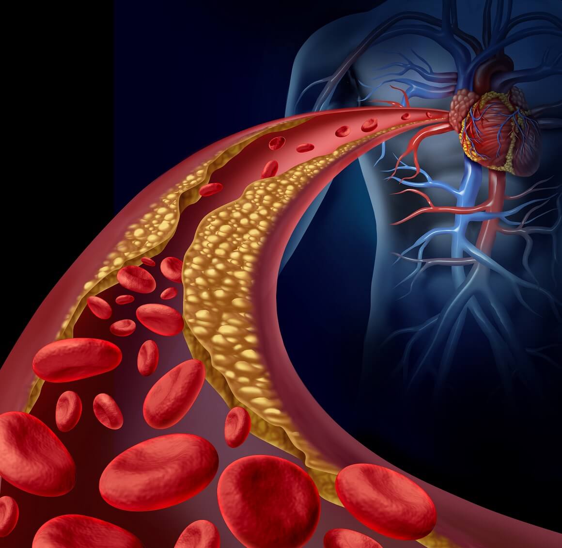 Visoke razine kolesterola lipoproteina niske gustoće (LDL) često dovode do taloženja masnih naslaga u stijenkama krvnih žila