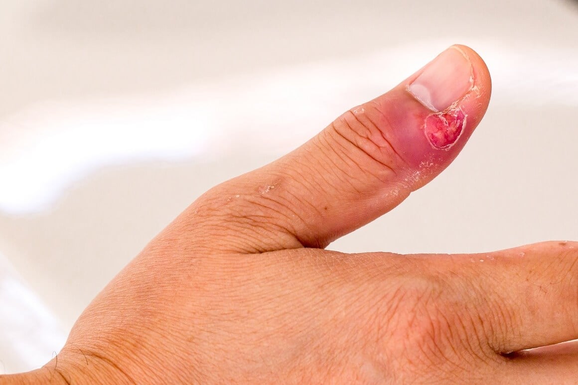 Zagnojena zanoktica na prstu