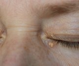 Simptomi bolesti jetre na koži