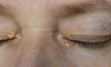 Simptomi bolesti jetre na koži