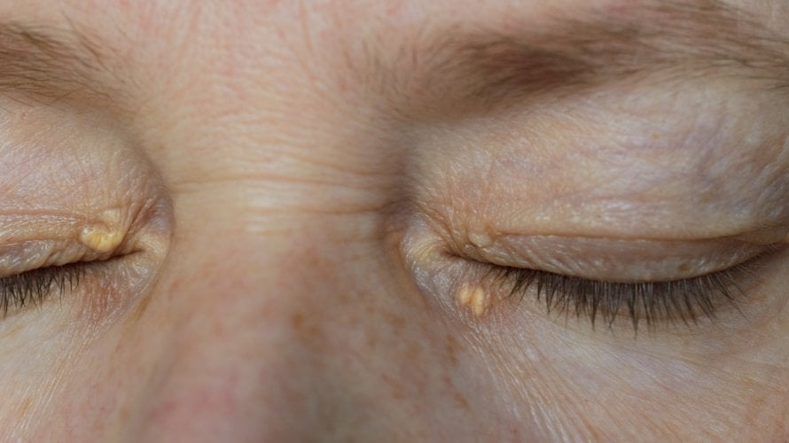 Simptomi bolesti jetre na koži