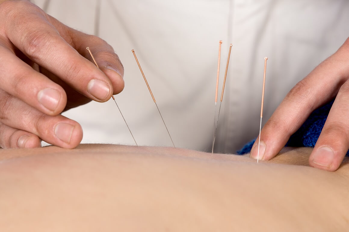 Akupunktura je alternativni oblik medicine koji potječe iz tradicionalne kineske medicine