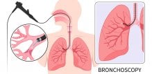 Bronhoskopski tretmani provode se kroz bronhoskop
