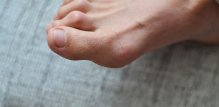 Čekićasti prst, karakteriziran abnormalnim savijanjem zglobova nožnih prstiju, obično zahvaća drugi nožni prst