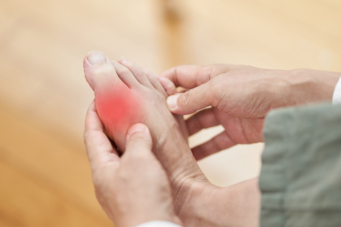 Giht, karakteriziran bolnim artritisom, prevladava među sredovječnim muškarcima