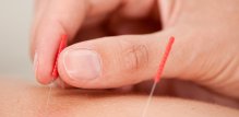 Metode akupunkture