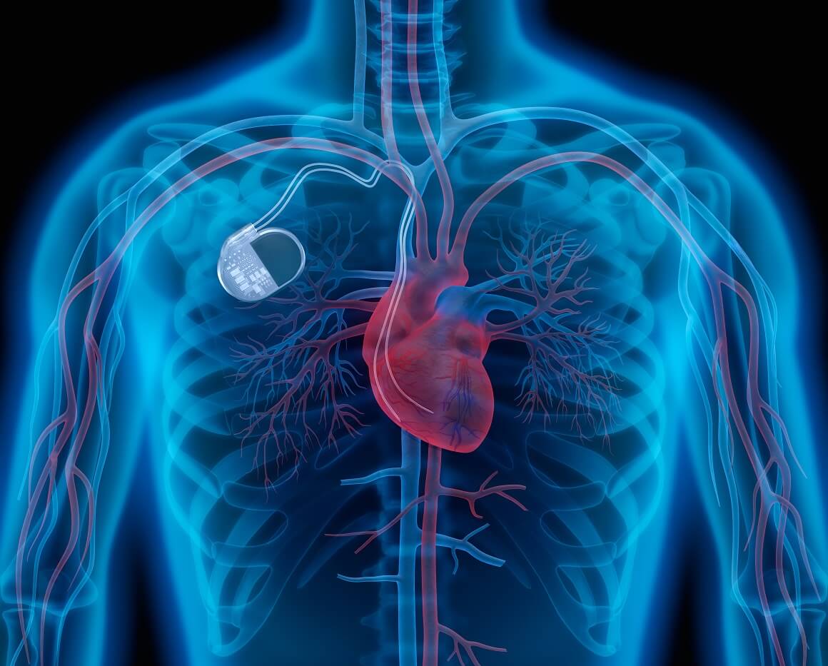 Pacemaker je uređaj koji regulira srčani ritam emitiranjem električnih signala ako detektira usporen rad srca