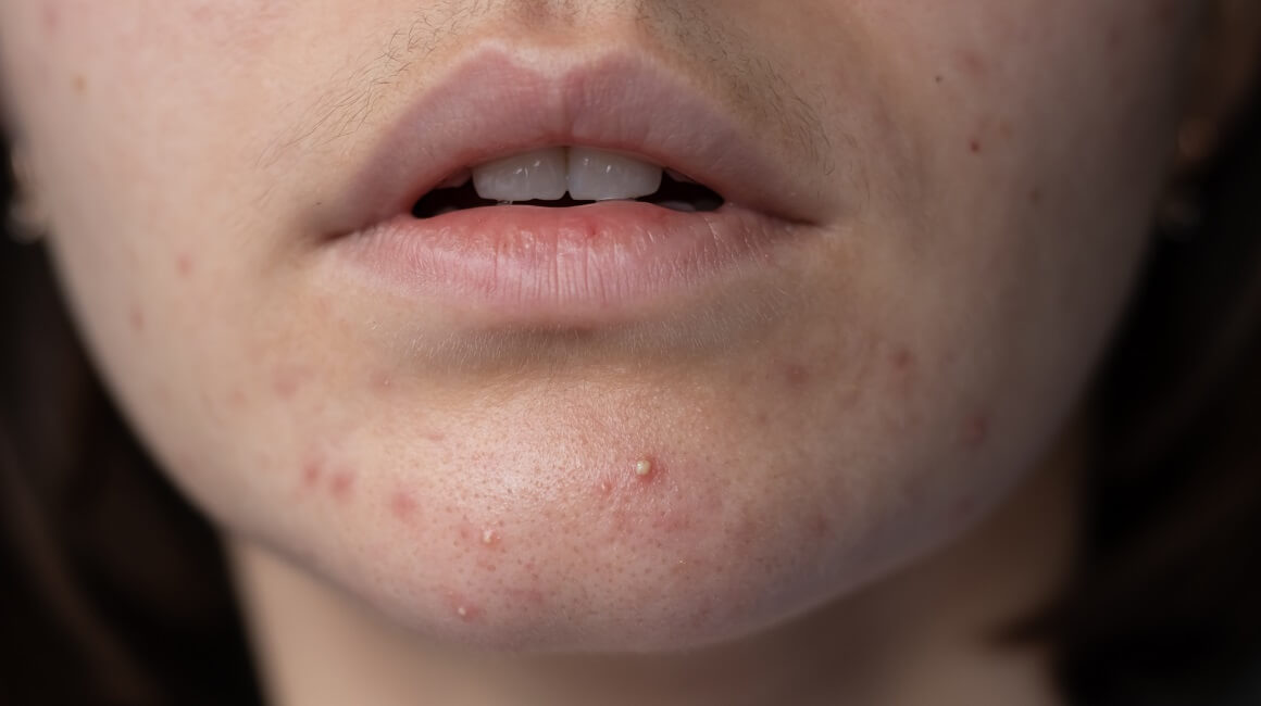 Vrste Pri ti a Evo Kako Ih Prepoznati I Lije iti