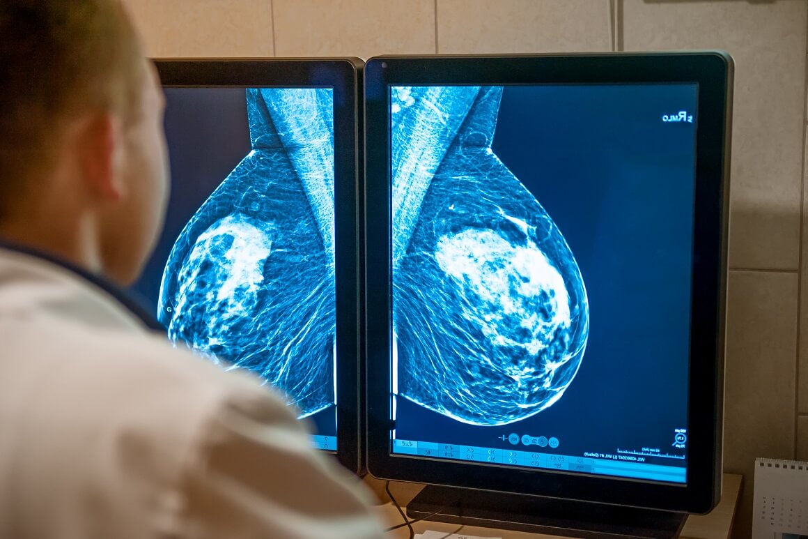 Mamogrami, iako nisu preventivni, rano otkrivaju rak