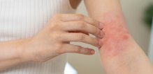 Pitta tip alergije