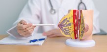 Uklanjanje limfnih čvorova oko dojke i pazuha kako bi se spriječilo širenje raka