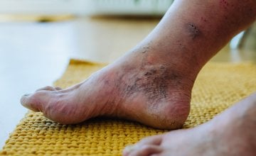 muškarci su suočeni s većim rizikom od velikih zdravstvenih komplikacija od dijabetesa nego žene