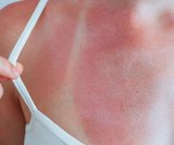 Čine li vaši lijekovi sunce dodatno opasnim za vašu kožu