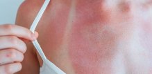 Čine li vaši lijekovi sunce dodatno opasnim za vašu kožu