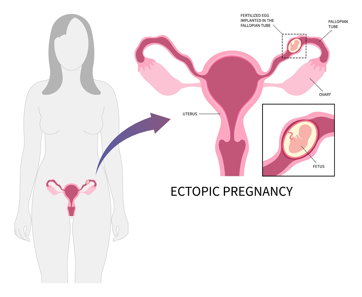 Ektopična trudnoća - simptomi