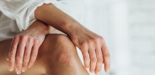 Simptomi psorijatičnog artritisa koji se prvi javljaju
