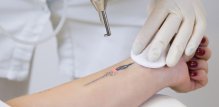 Skidanje tetovaže laserom