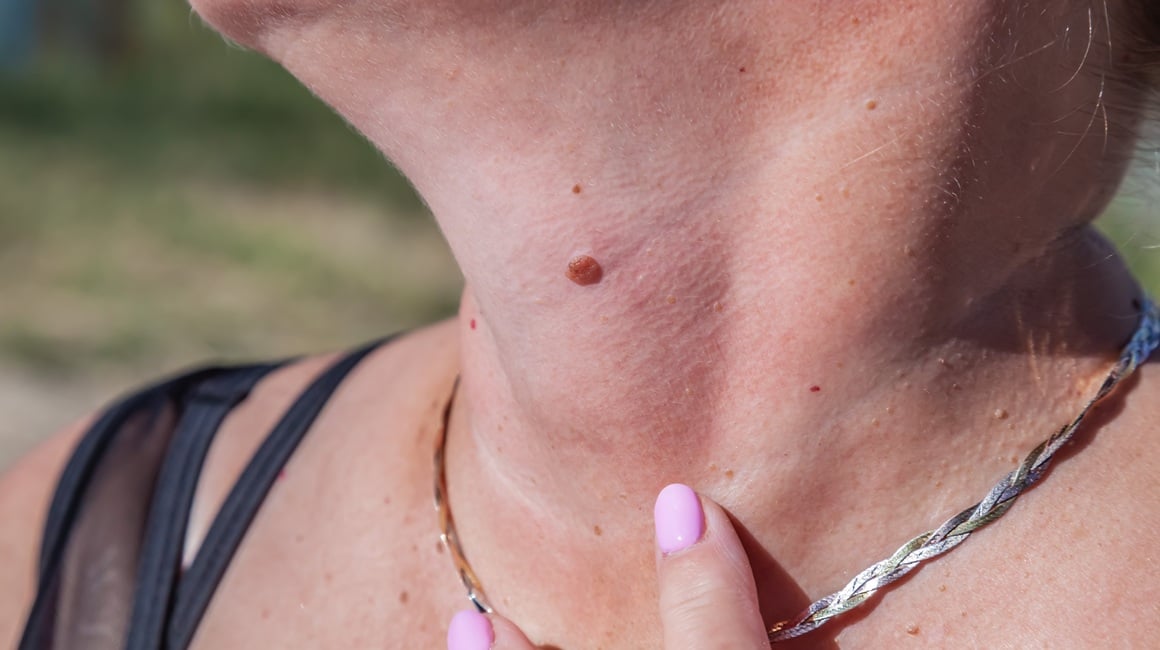 Simptomi raka kože: Ako primijetite ovih 7 promjena, javite se dermatologu