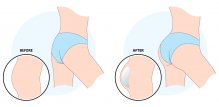 Brazilian butt lift