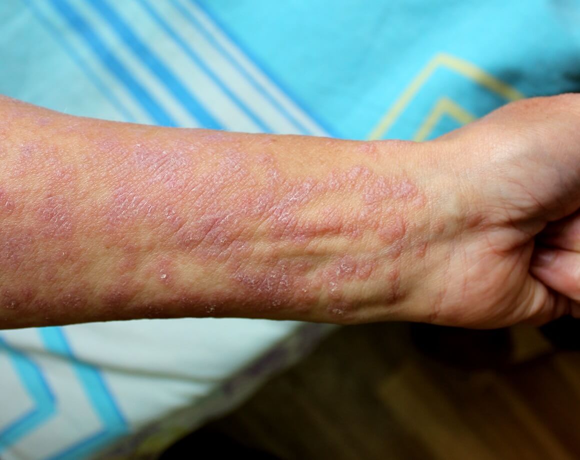 Lichen planus