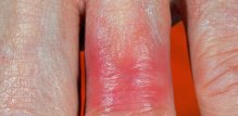 Nikal je jedan od vodećih okidača za kontaktni dermatitis