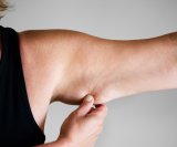 višak masnoće na rukama