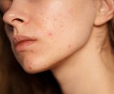 Mitovi o aknama i prehrani u koje možete prestati vjerovati