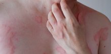 Najozbiljnija alergijska reakcija na lateks je anafilaksija