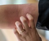 atopijski dermatitis pogađa milijune djece i odraslih